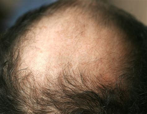 A Bald Spot On A Man S Head Alopecia Hair Loss Stock Photo Image Of