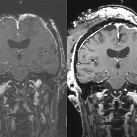 Neuroradiologic Magnetic Resonance Imaging During Acute Cerebritis