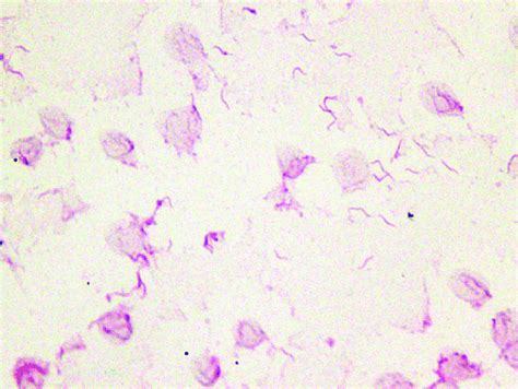 A Gram Stain Of The Positive Blood Culture Showing The