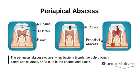 Dental Abscess Symptoms Causes And Treatment With Pictures