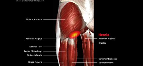 Thighhernialarge Thermoskin Supports And Braces For Injury And