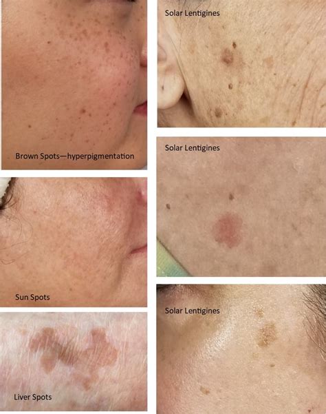 How To Get Rid Of Red Sun Spots On Face Learn Which Age Spot Skin Treatments Actually Work