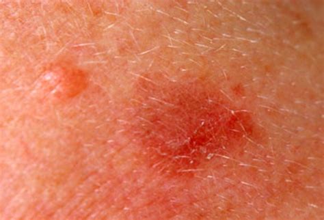 Malignant melanoma arising within a seborrhoeic keratosis. Actinic Keratosis - Pictures, Causes and Treatment - (2021 ...