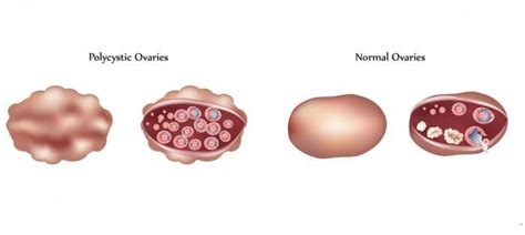 Polycystic Ovarian Syndrome Monterey Ca The Fertility And Gynecology Center Monterey Bay Ivf