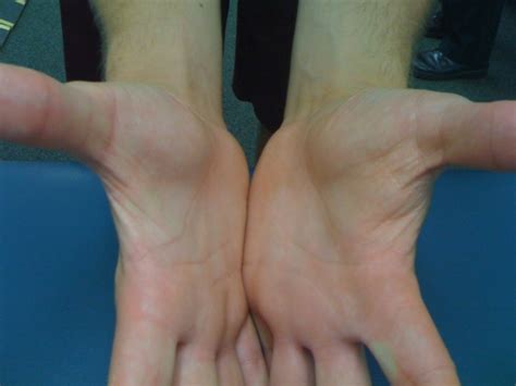 Ulnar Neuropathy In Pitchers Article Details Pallof Physical Therapy