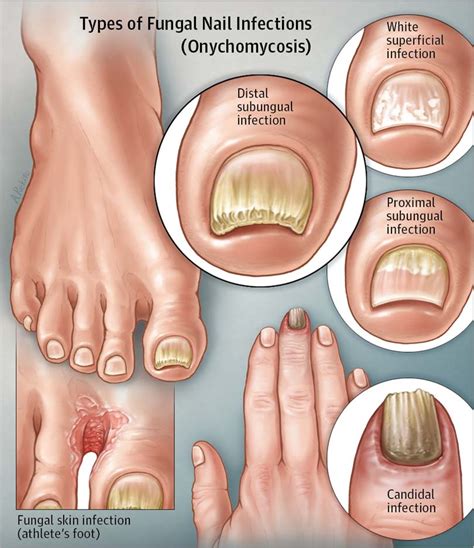 Discover More Than 124 Fungal Nail Infection Onychomycosis Noithatsi Vn
