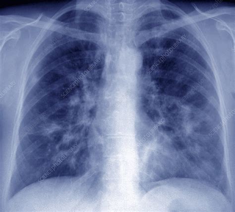 Diffuse Interstitial Pneumonia Lung X Ray Stock Image