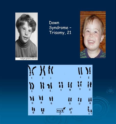 Key findings in trisomy 21 (see fig. PPT - Chromosomes PowerPoint Presentation - ID:838339