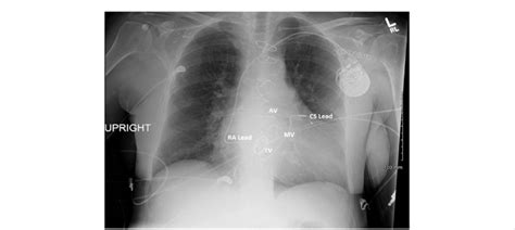 Chest X Ray With Coronary Sinus Lead Placement Download Scientific