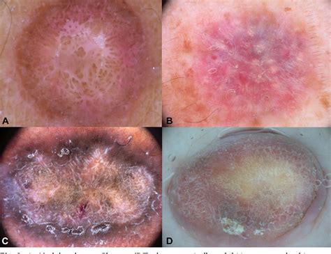 Figure 1 From The Dermoscopic Variability Of Dermatofibromas