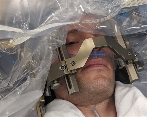 The Agony And The Ecstacy Of Deep Brain Stimulation Surgery Laptrinhx