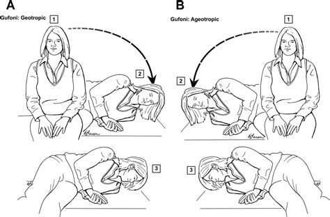 Benign Paroxysmal Positional Vertigo In The Acute Care Setting
