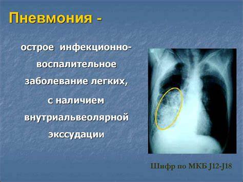 Пневмония у детей. Принципы лечения и профилактики - презентация онлайн Картинка - Пневмония у детей. Принципы лечения и профилактики - презентация онлайн