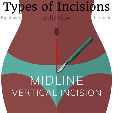 Types Of Surgical Incisions Sterilizationaunty