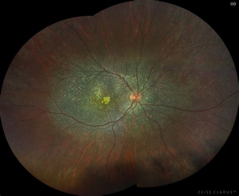 Biettis Crystalline Dystrophy Retina Image Bank