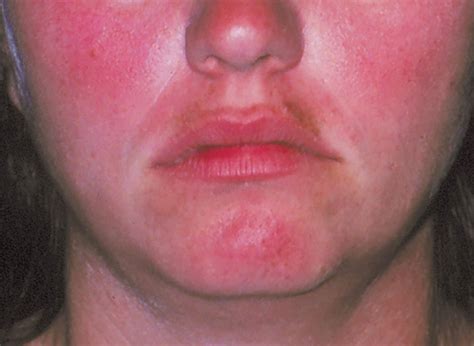 Facial Redness Treatment Bristol Ciao Bella Aesthetics