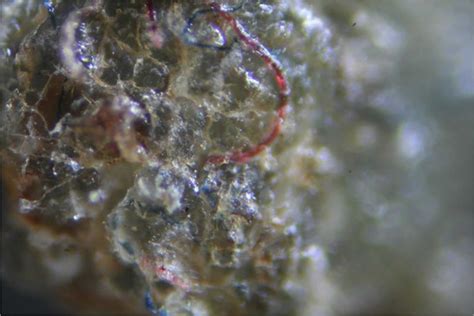 Morgellons Disease Causes Symptoms Stages And Treatment