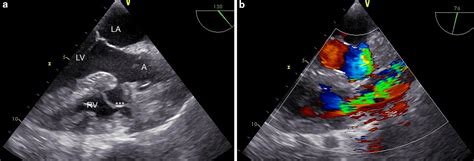 Dynamic Right Ventricular Outflow Tract Obstruction Caused By A Large