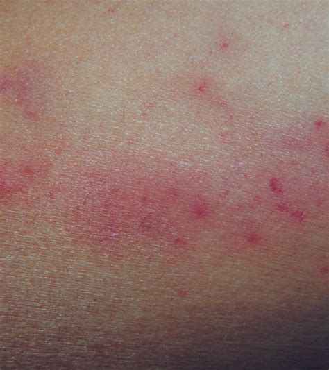 Petechiae In Children Causes Symptoms And Treatment