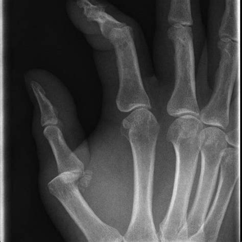 Radiograph Of A Metacarpophalangeal Volar Dislocation Of The First Download Scientific Diagram