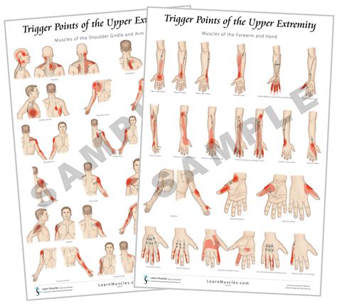 Trigger Point Upper Extremity 24 X 36 Premium Poster 2 Pack Learn