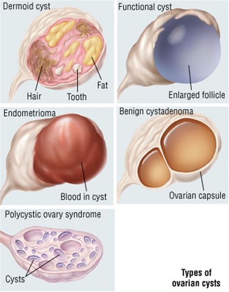 what causes ovarian cysts