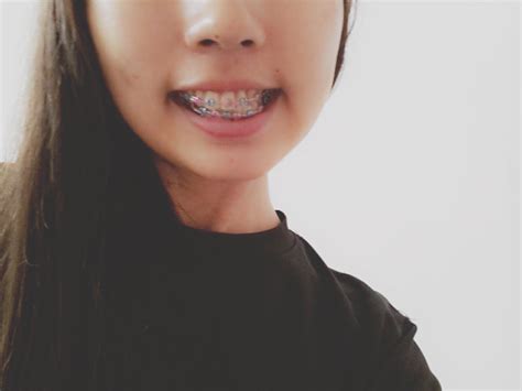 Went hot pink from lime green today! Braces Journey - εlyssa | ѕzεкі
