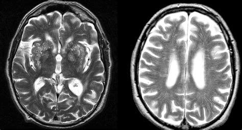 Enlarged Perivascular Spaces On Mri Are A Feature Of Cerebral Small
