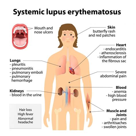 Lupus Causes Symptoms And Research