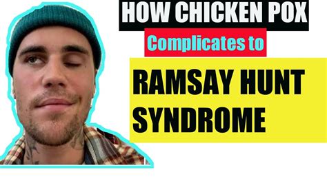 What Is Ramsay Hunt Syndrome Causes Signs Symptoms And Treatment