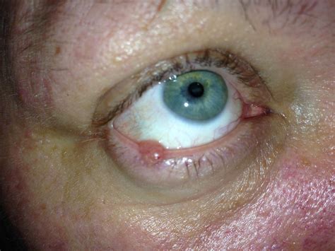 How A Denver Oculoplastic Surgeon Treats Skin Cancer On The Eyelid My