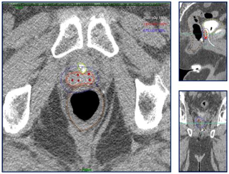 Outcomes Of Salvage High Dose Rate Brachytherapy With Or Without Pelvic External Beam