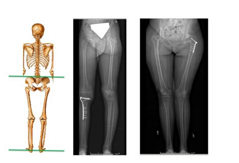 Eos Hips To Ankles Elements Of Radiography