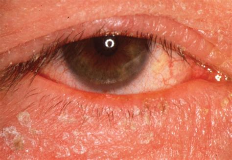 Diagnosis And Management Of Blepharitis