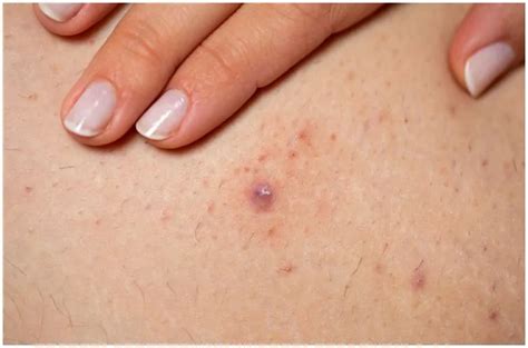 Folliculitis Vs Herpes Differences Health Guide Net