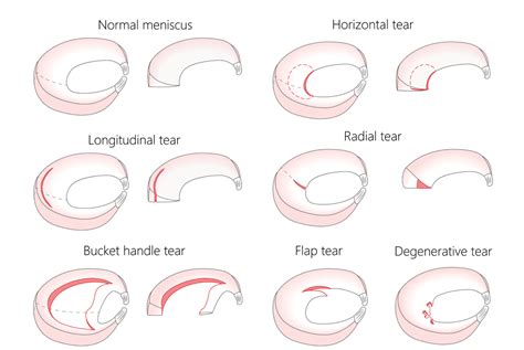 Meniscus Tears Symptoms And Treatments Orthopaedic Au