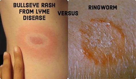 Ringworm And Lyme Disease Are Two Very Different Conditions That Can