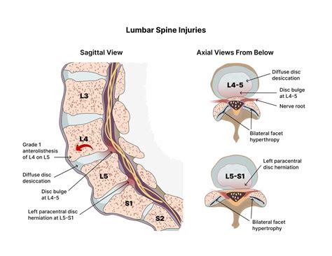 What You Need To Know About The L5 S1 Lumbosacral Joint
