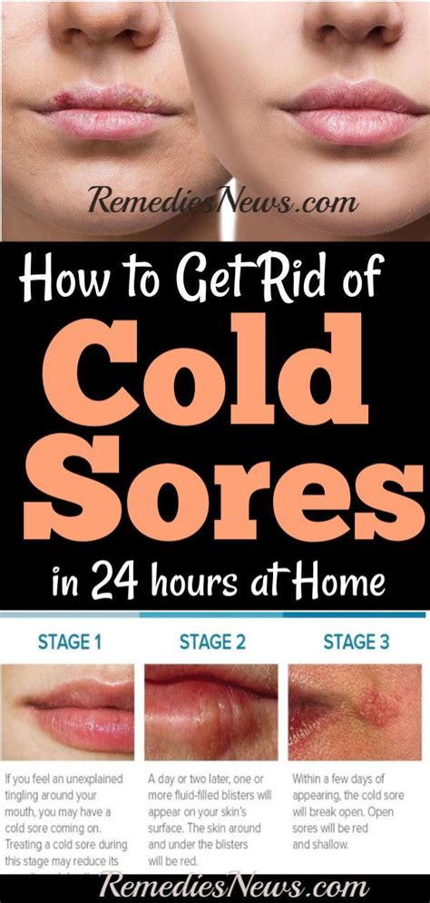 Quick Way To Clear Cold Sores Just For Guide