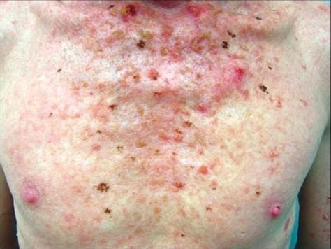 Actinic Keratosis Ak Concise Medical Knowledge