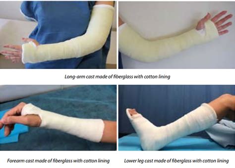 Care Of Casts And Splints Fv Hospital