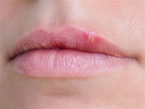 Blisters On Lips Not Herpes