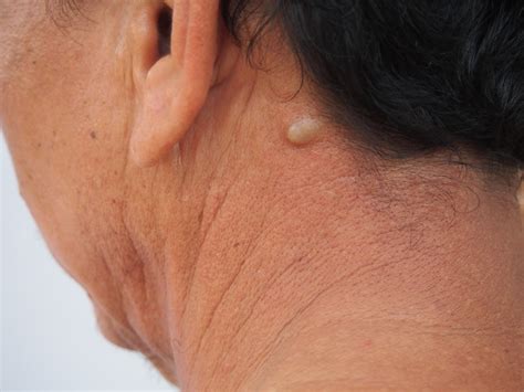Sebaceous Cyst Removal The Wells Clinic Private Gp Clinic