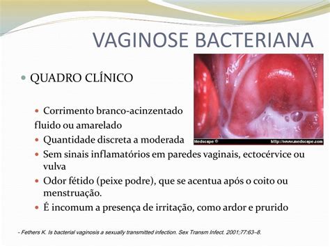 Ppt Vulvovaginites Powerpoint Presentation Free Download Id4274079