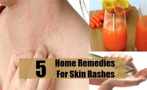 5 Home Remedies For Skin Rashes Natural Cure And Herbal Treatment For