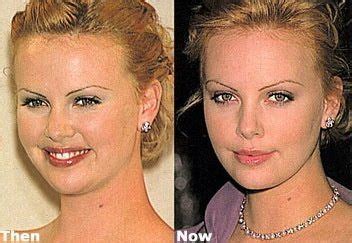 Charlez What Happened Plastic Surgery Cosmetic Surgery Celebrity