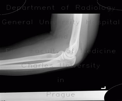 Radiology Case Sail Sign Elbow Joint Effusion