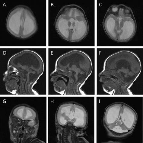 A Case Of Tuba1a Mutation Presenting With Lissencephaly And