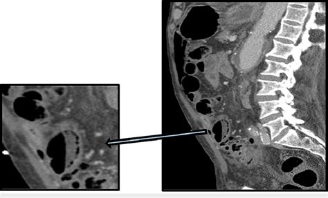 Contrast Enhanced Sagittal Image With Magnified View Demonstrates Gas