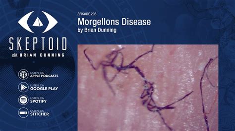 Morgellons Disease Symptoms